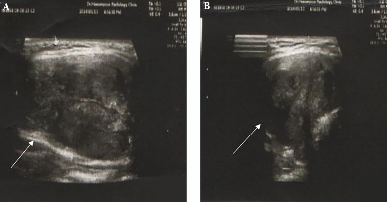 A Pediatric Parathyroid Carcinoma: An Unusual Clinical Presentation and Mini-review.