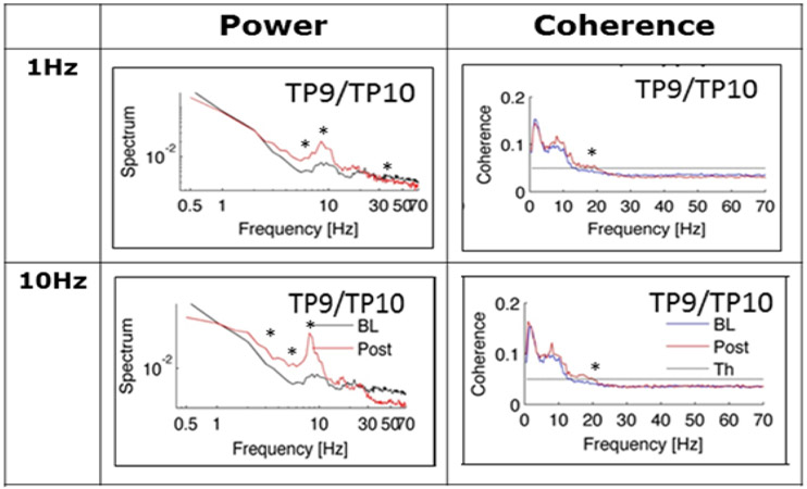 Change in EEG Activity is Associated with a Decrease in Tinnitus Awareness after rTMS.