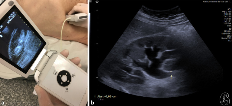 [Clinical ultrasound in nephrology].