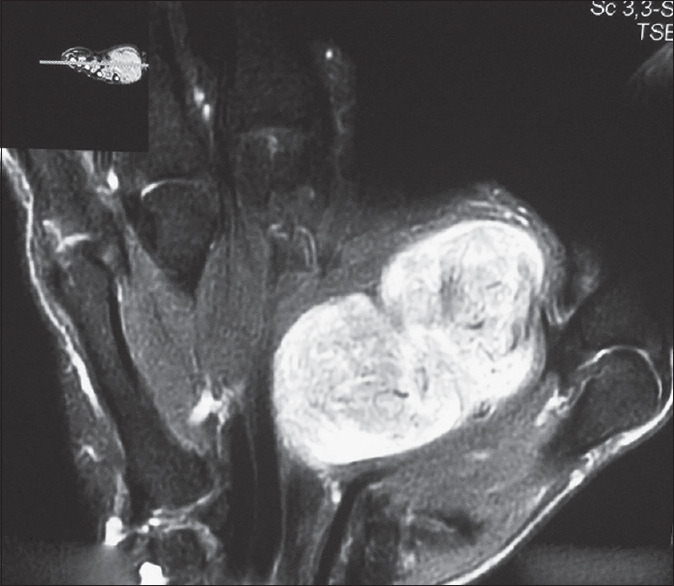 Giant Schwannoma on Thenar Aspect of the Hand: A Rare Case Report.