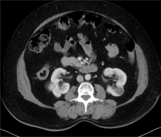 Bilateral Single-Stage Nephrectomy for Synchronous Bilateral Renal Cell Carcinoma.