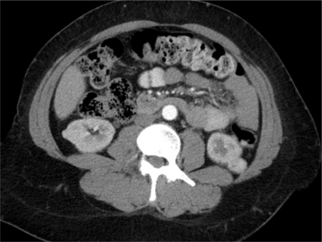 Bilateral Single-Stage Nephrectomy for Synchronous Bilateral Renal Cell Carcinoma.