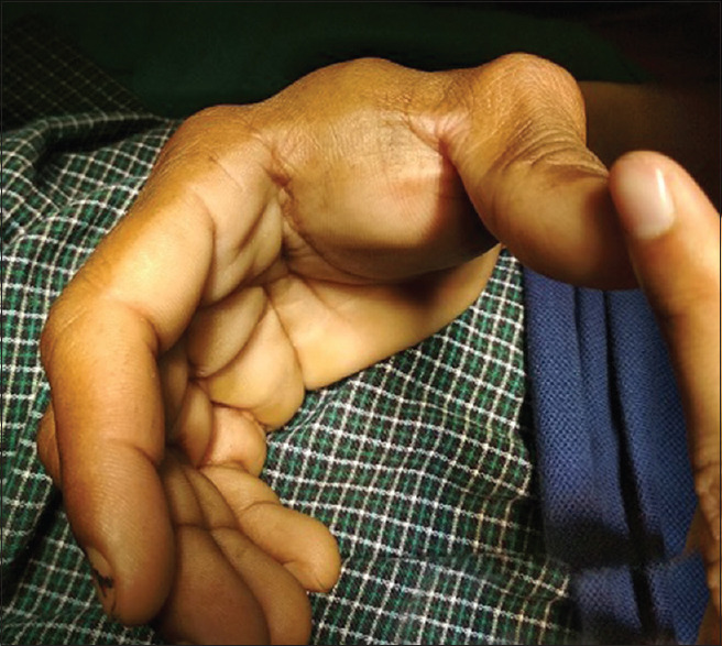 Giant Schwannoma on Thenar Aspect of the Hand: A Rare Case Report.