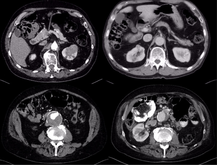 Bilateral Single-Stage Nephrectomy for Synchronous Bilateral Renal Cell Carcinoma.