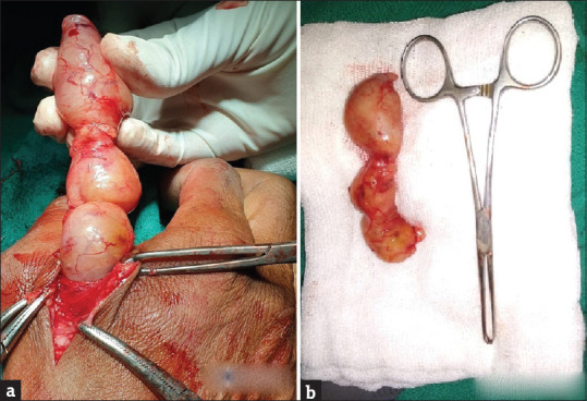Giant Schwannoma on Thenar Aspect of the Hand: A Rare Case Report.