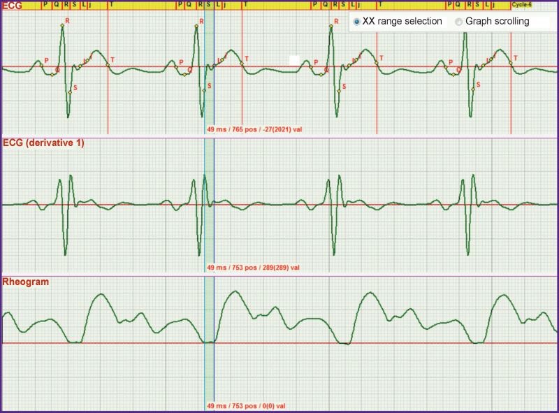 The Exact Definition of the Boundary between the Rapid and Slow Ejection Phases on ECGs and Accurate Location of the j Point.