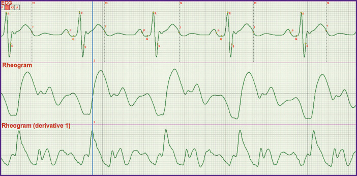 The Exact Definition of the Boundary between the Rapid and Slow Ejection Phases on ECGs and Accurate Location of the j Point.