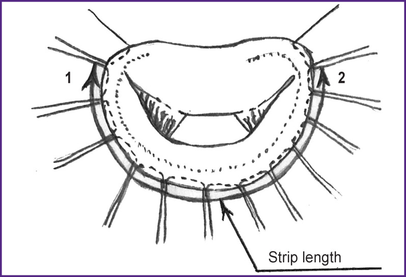 Modified Mitral Valve Repair with Its Insufficiency of Ischemic Genesis.