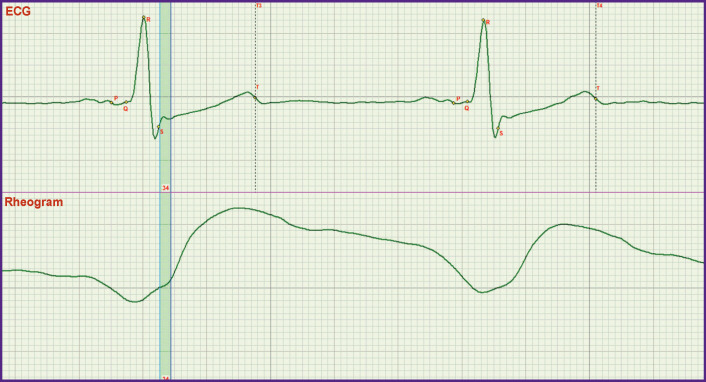 The Exact Definition of the Boundary between the Rapid and Slow Ejection Phases on ECGs and Accurate Location of the j Point.