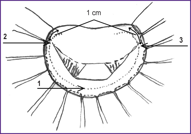 Modified Mitral Valve Repair with Its Insufficiency of Ischemic Genesis.