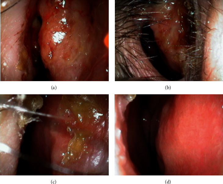 Fish Tank Granuloma Presenting as a Nasal Cavity Mass.