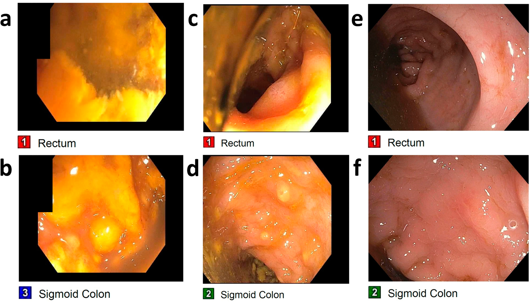 Hospitalized Older Patients with <i>Clostridioides difficile</i> Infection Refractory to Conventional Antibiotic Therapy Benefit from Fecal Microbiota Transplant.