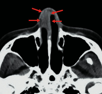 Fish Tank Granuloma Presenting as a Nasal Cavity Mass.