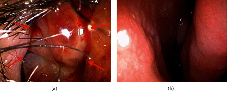 Fish Tank Granuloma Presenting as a Nasal Cavity Mass.