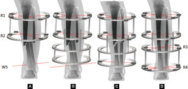 Ilizarov Method for Acute Paediatric Tibial Fractures.