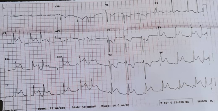 Spinal Anesthesia Using Ultra-Low-Dose Isobaric Bupivacaine with Intrathecal Morphine-Fentanyl for Bilateral Low Extremity Procedures in a Geriatric Patient with Recent Myocardial Infarction and Percutaneous Coronary Intervention.