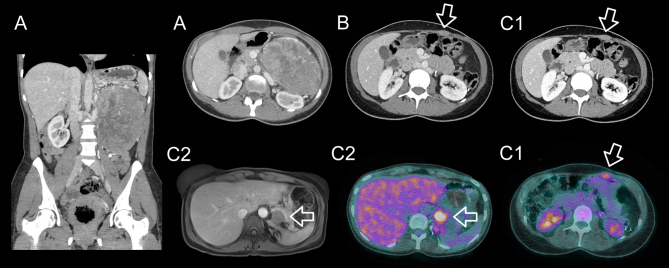 Adrenocortical cancer recurrence following initial transcutaneous biopsy: a rare demonstration of needle tract seeding.