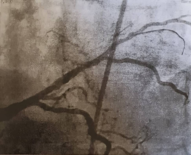 Spinal Anesthesia Using Ultra-Low-Dose Isobaric Bupivacaine with Intrathecal Morphine-Fentanyl for Bilateral Low Extremity Procedures in a Geriatric Patient with Recent Myocardial Infarction and Percutaneous Coronary Intervention.