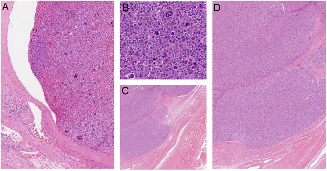 Adrenocortical cancer recurrence following initial transcutaneous biopsy: a rare demonstration of needle tract seeding.