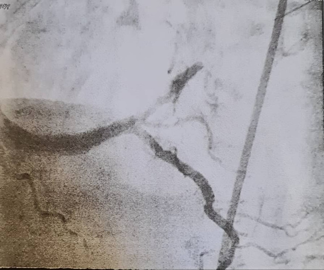 Spinal Anesthesia Using Ultra-Low-Dose Isobaric Bupivacaine with Intrathecal Morphine-Fentanyl for Bilateral Low Extremity Procedures in a Geriatric Patient with Recent Myocardial Infarction and Percutaneous Coronary Intervention.