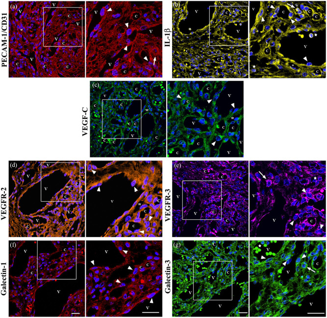 Plump endothelial cells integrated into pre-existing venules contribute to the formation of 'mother' and 'daughter' vessels in pyogenic granuloma: possible role of galectin-1, -3 and -8.