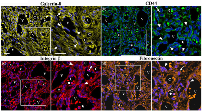 Plump endothelial cells integrated into pre-existing venules contribute to the formation of 'mother' and 'daughter' vessels in pyogenic granuloma: possible role of galectin-1, -3 and -8.