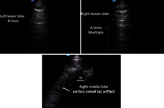 A Case of Bedside Ultrasound in COVID-19 to Prognosticate Functional Lung Recovery.