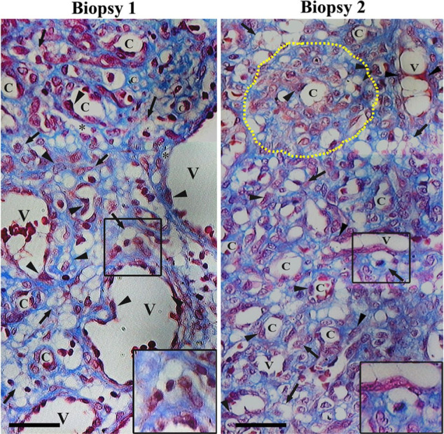 Plump endothelial cells integrated into pre-existing venules contribute to the formation of 'mother' and 'daughter' vessels in pyogenic granuloma: possible role of galectin-1, -3 and -8.