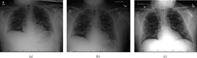 A Case of Bedside Ultrasound in COVID-19 to Prognosticate Functional Lung Recovery.