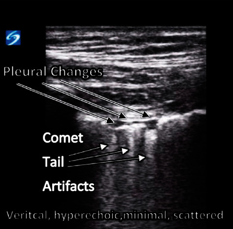 A Case of Bedside Ultrasound in COVID-19 to Prognosticate Functional Lung Recovery.