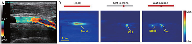 SARS-CoV-2-related vascular injury: mechanisms, imaging and models.