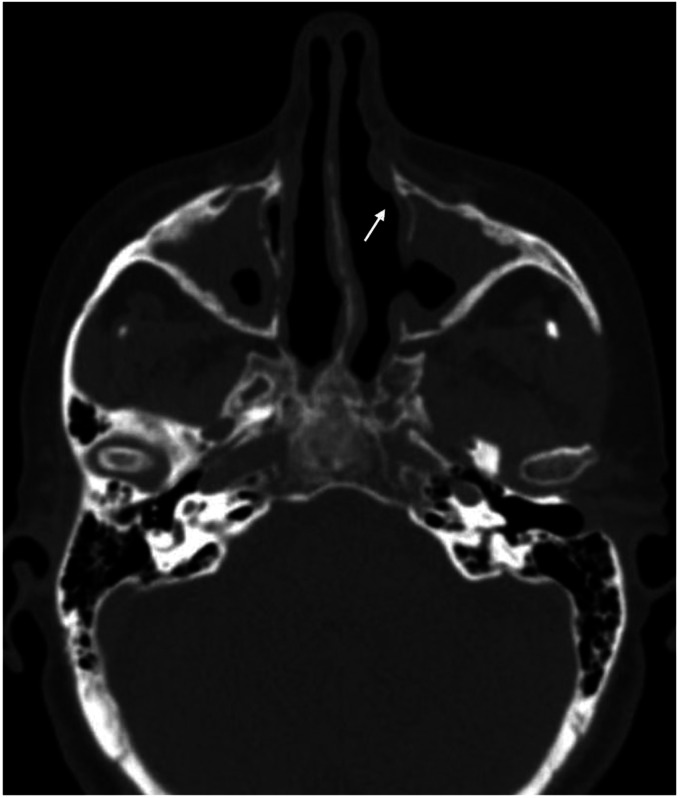 Cholesterol Granuloma of the Maxillary Sinus-A Case Report and Literature Review.