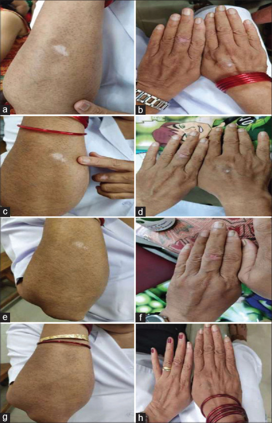 Efficacy of external application of oil and gel dosage forms of <i>Aragvadhadi</i> formulation in combination with <i>Rasayana Churna</i> in the management of <i>Shwitra</i> (vitiligo) - An open-labeled comparative clinical trial.