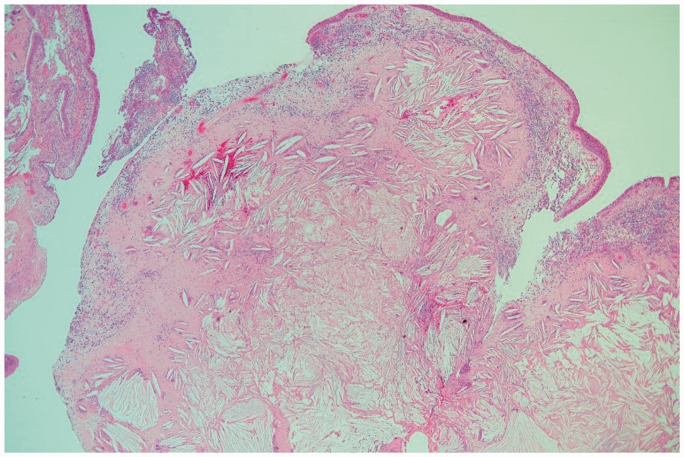 Cholesterol Granuloma of the Maxillary Sinus-A Case Report and Literature Review.