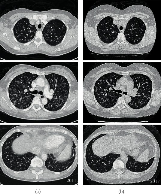 Asymptomatic Lymphocytic Interstitial Pneumonia with Extensive HRCT Changes Preceding Sjogren's Syndrome.