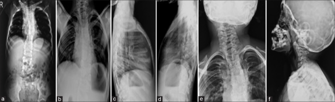 A case report of Jarcho-Levin syndrome.