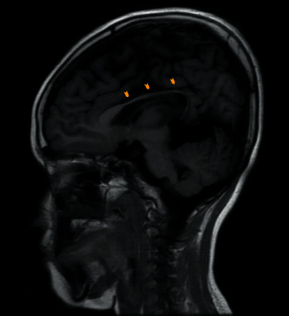 Epilepsy as a Presentation of a Neuroglial Cyst Associated with Dysgenesis of Corpus Callosum in a Child.