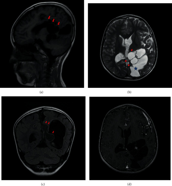 Epilepsy as a Presentation of a Neuroglial Cyst Associated with Dysgenesis of Corpus Callosum in a Child.