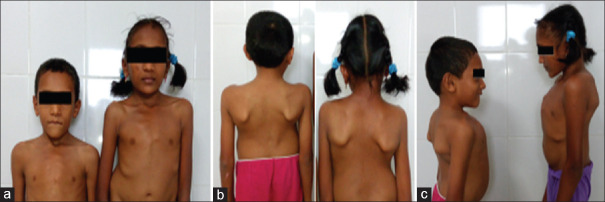 A case report of Jarcho-Levin syndrome.