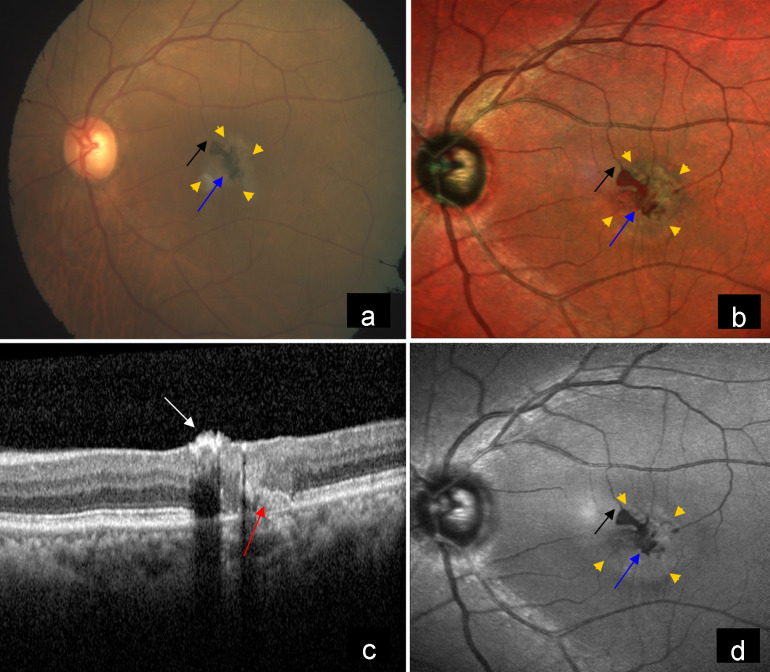 An unusual presentation of macular telangiectasia type 2 with a large pigment deposit.