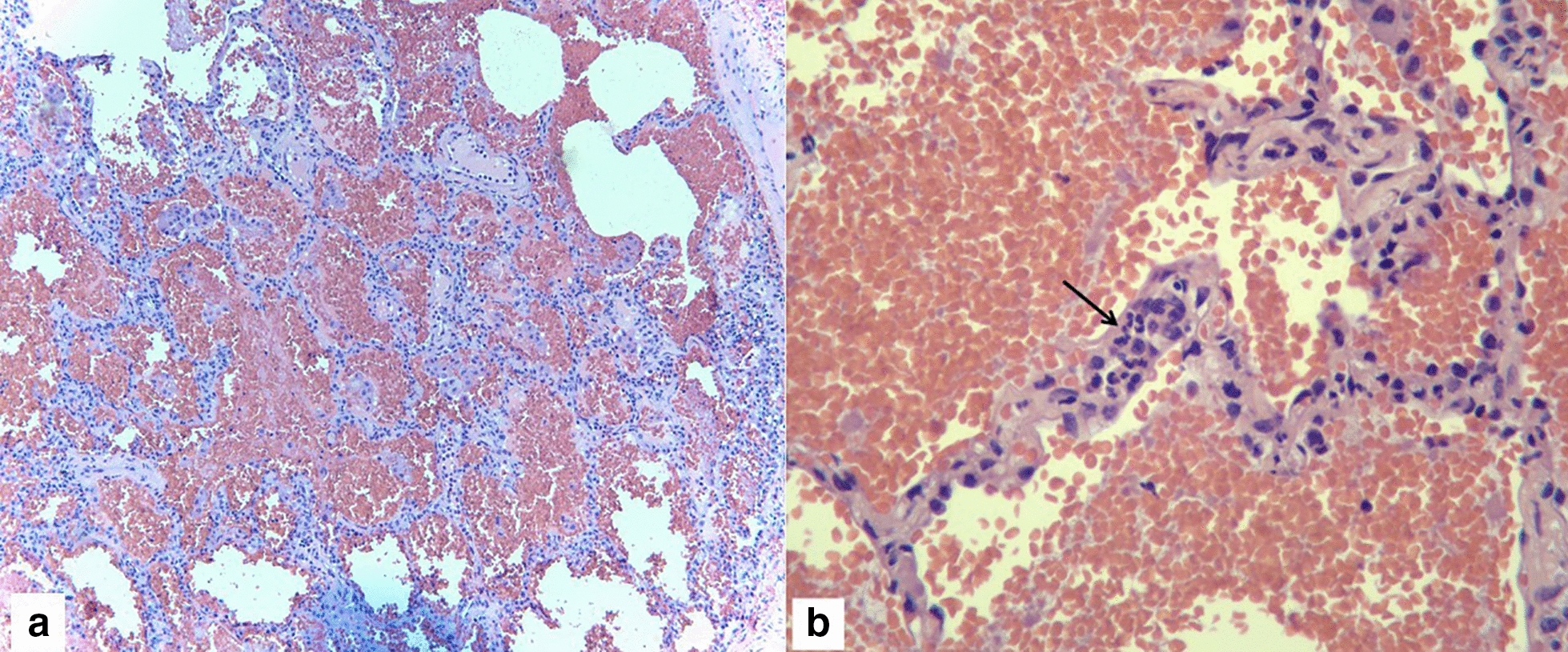 ANCA-negative microscopic polyangiitis with diffuse alveolar hemorrhage masquerading as congestive heart failure.