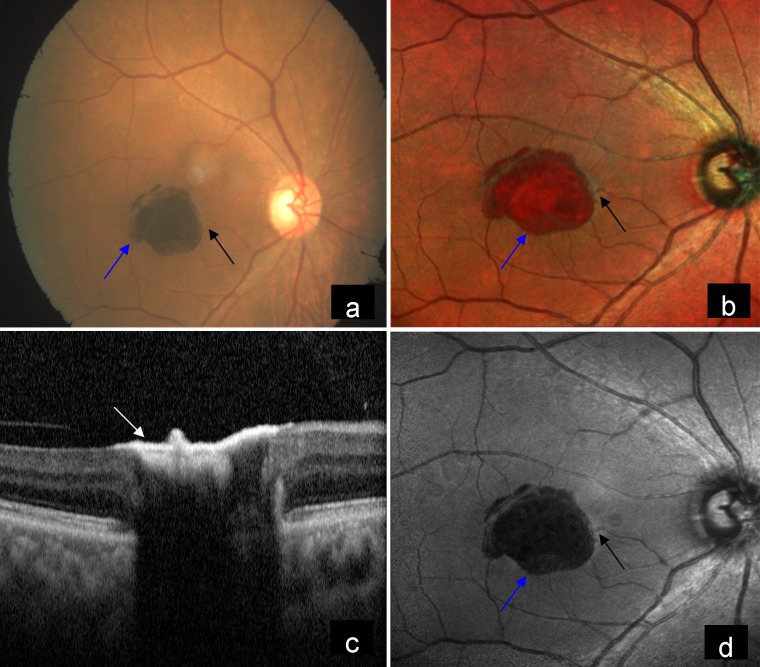 An unusual presentation of macular telangiectasia type 2 with a large pigment deposit.