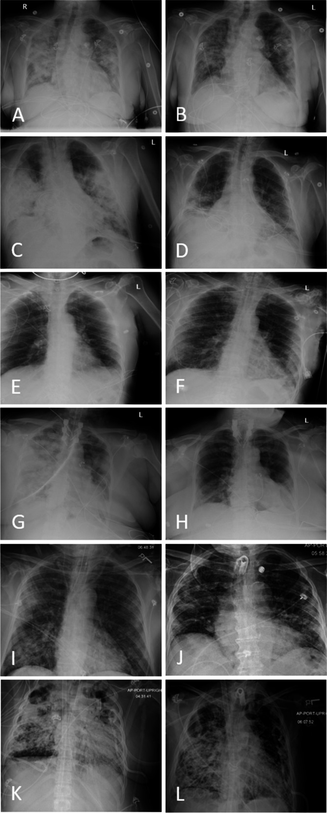 Mesenchymal stem cells in the treatment of severe COVID-19.