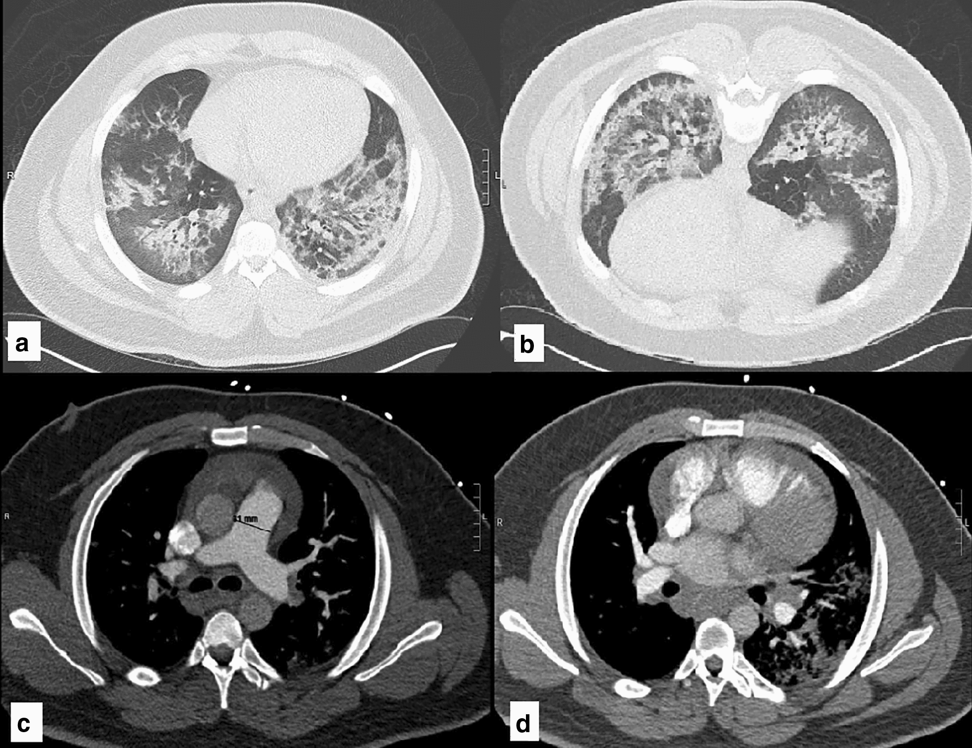 ANCA-negative microscopic polyangiitis with diffuse alveolar hemorrhage masquerading as congestive heart failure.