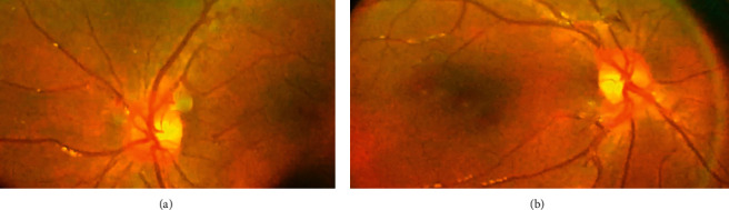 Optic Neuritis Presented as Syndrome of Inappropriate Antidiuretic Hormone Secretion in an 8 Year Old.