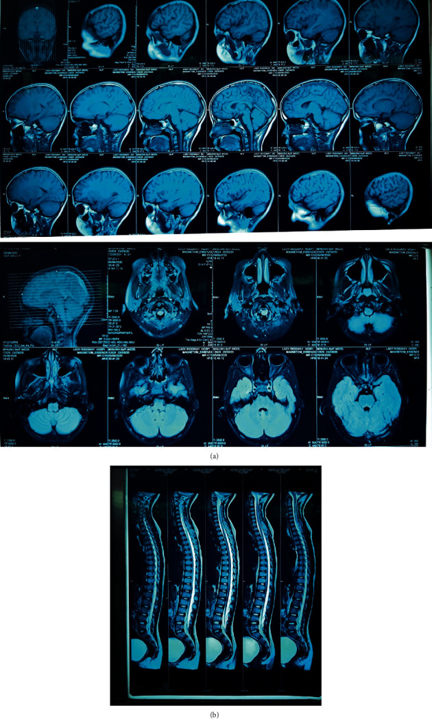 Optic Neuritis Presented as Syndrome of Inappropriate Antidiuretic Hormone Secretion in an 8 Year Old.