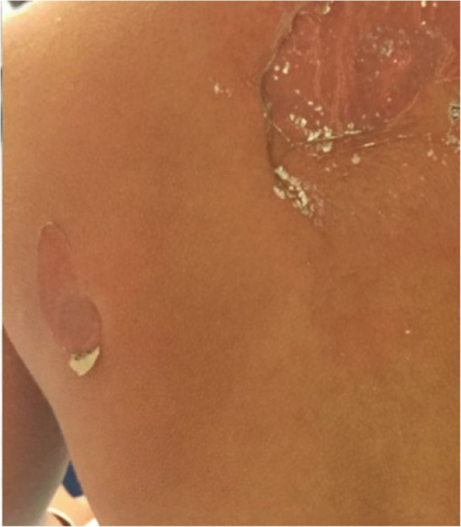 Management of Infectious Emergencies for the Inpatient Dermatologist.