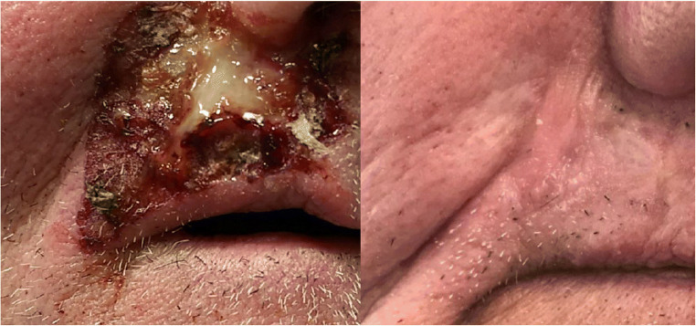 Management of Infectious Emergencies for the Inpatient Dermatologist.