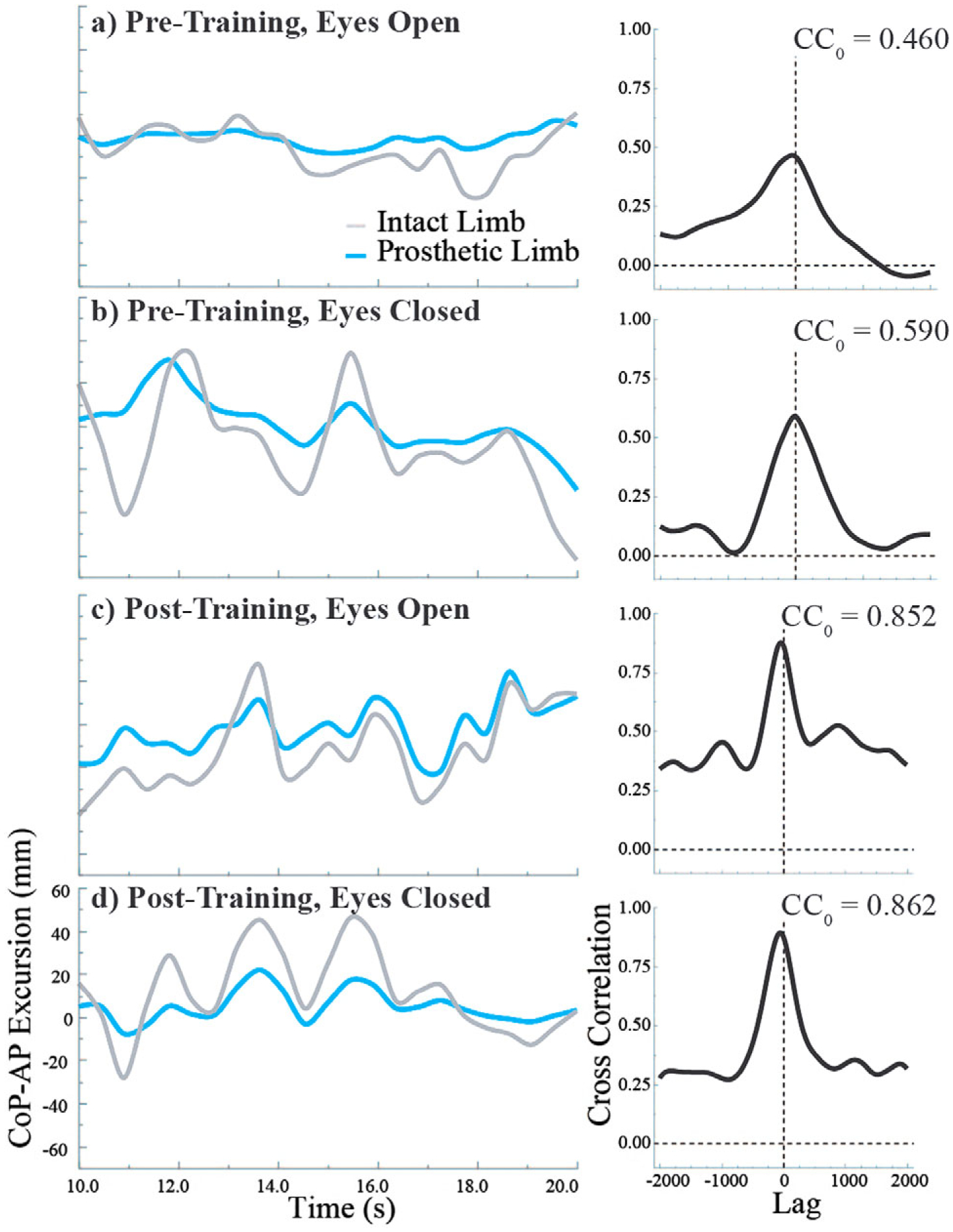 Direct continuous electromyographic control of a powered prosthetic ankle for improved postural control after guided physical training: A case study.