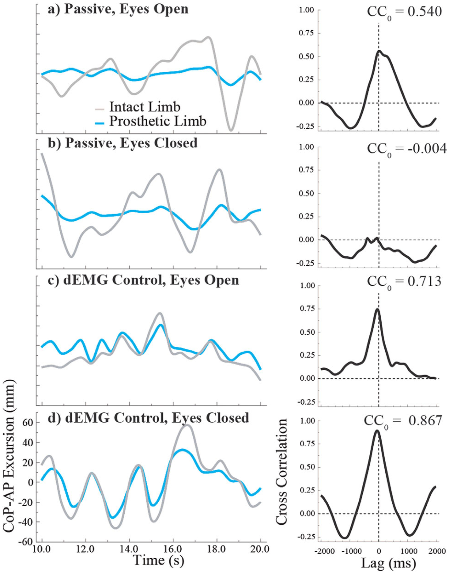 Direct continuous electromyographic control of a powered prosthetic ankle for improved postural control after guided physical training: A case study.